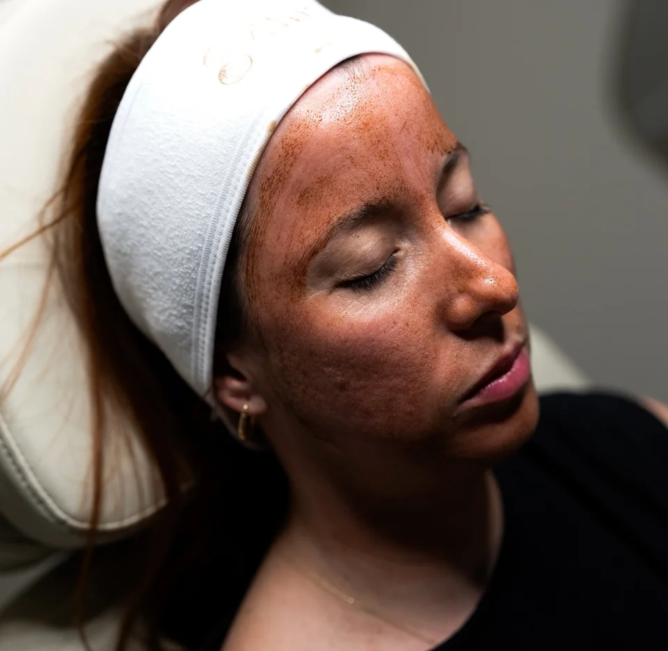 Chemical Peels in Miami: A Complete Guide to Skin Renewal at a Boutique Medspa