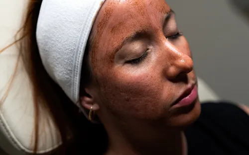 Chemical Peels in Miami: A Complete Guide to Skin Renewal at a Boutique Medspa