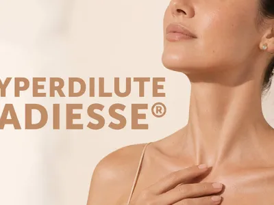Hyperdilute Radiesse in Miami: How It Tightens Skin