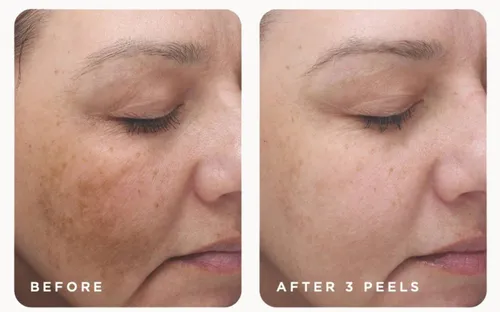 Hyperpigmentation Treatment in Miami: Dark Spots, Melasma & Uneven Tone — What Actually Works