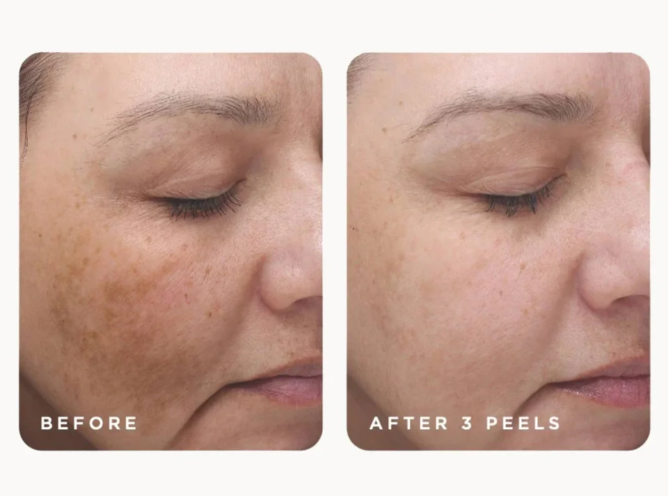 Hyperpigmentation Treatment in Miami: Dark Spots, Melasma & Uneven Tone — What Actually Works