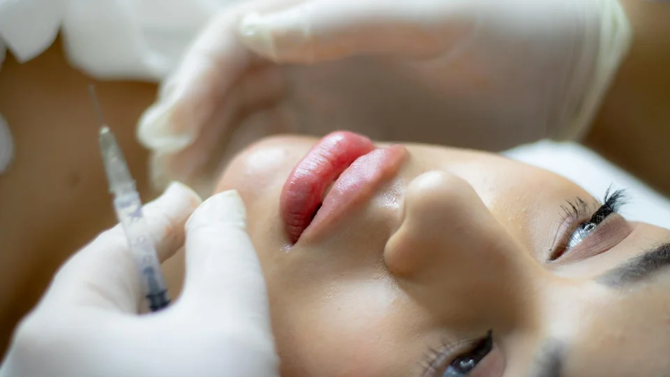 Lip Fillers in Miami: Your Complete Guide to Natural-Looking Results