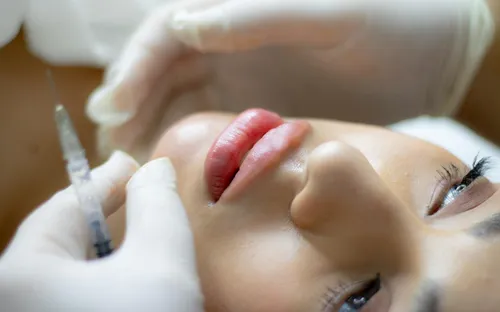 Lip Fillers in Miami: Your Complete Guide to Natural-Looking Results