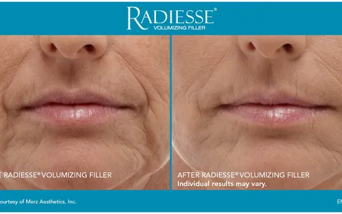 How Much Does Radiesse Cost in Miami? (2026 Guide)