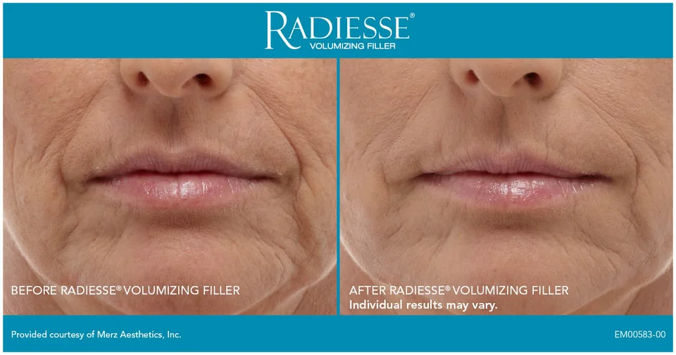 How Much Does Radiesse Cost in Miami? (2026 Guide)