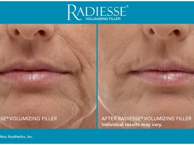 How Much Does Radiesse Cost in Miami? (2026 Guide)
