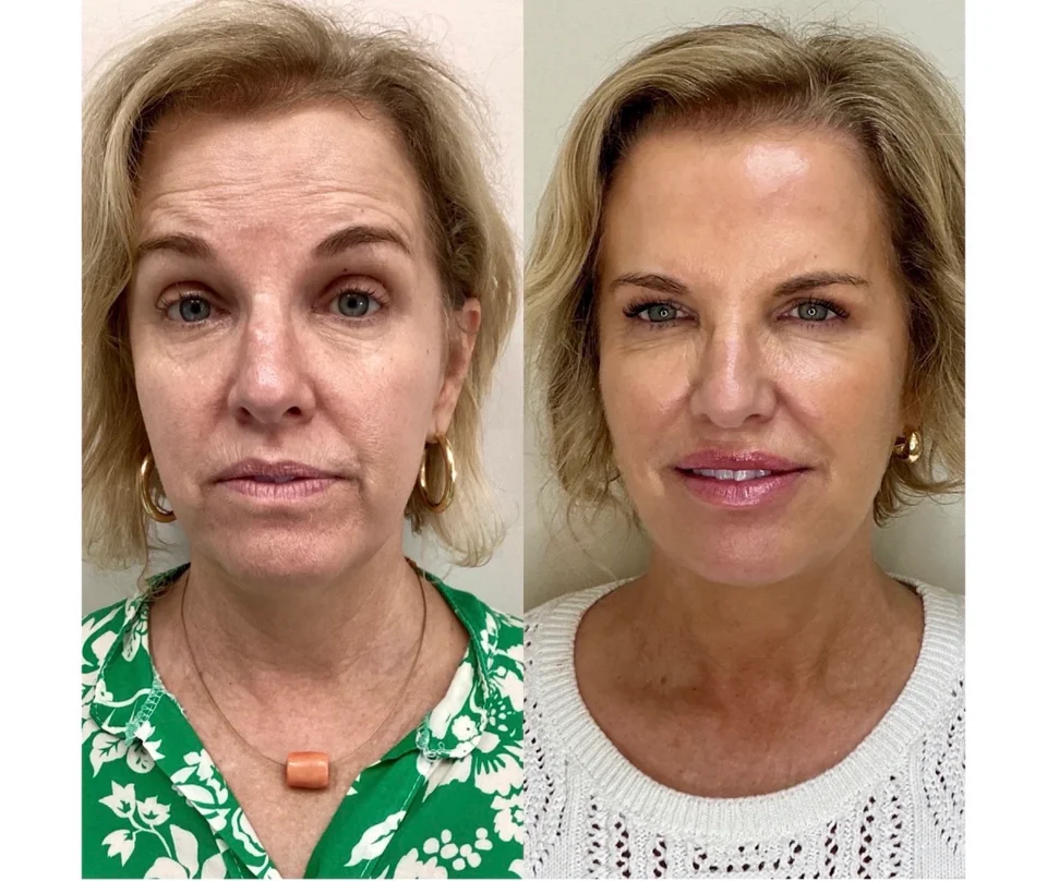 How Much Does Sculptra Cost in Miami? (2026 Pricing Guide)