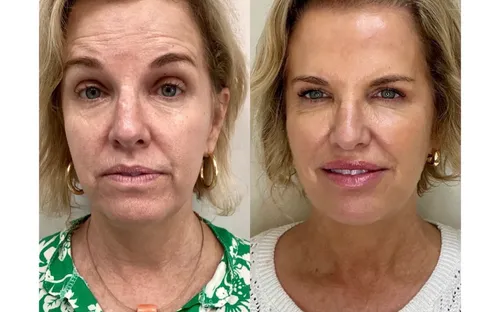 How Much Does Sculptra Cost in Miami? (2026 Pricing Guide)