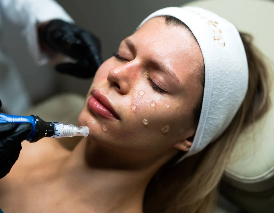 Morpheus8 vs. SkinPen Microneedling in Miami: Why We Chose SkinPen
