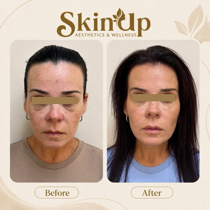 This is what true full-face rejuvenation looks like—without overfilling. ✨

We used Dysport, strategically placed dermal filler to restore m